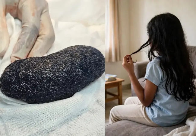 Rapunzel-Syndrome